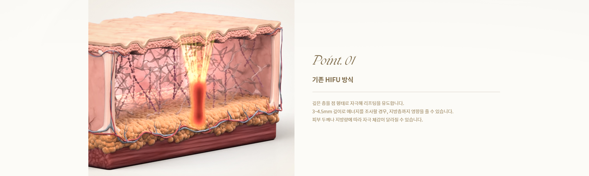 [Point. 01] [기존 HIFU 방식] 깊은 층을 점 형태로 자극해 리프팅을 유도합니다.